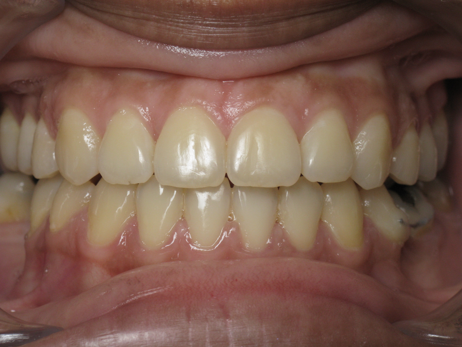 Orthodontic Treatment Case Study